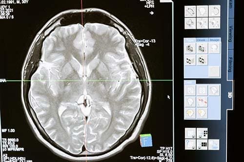 Hyperbaric Chamber Brain Health