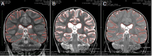 anorexic brain injury hbot