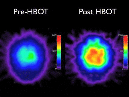 BRAIN CHANGES WITH HYPERBARIC OXYGEN THERAPY